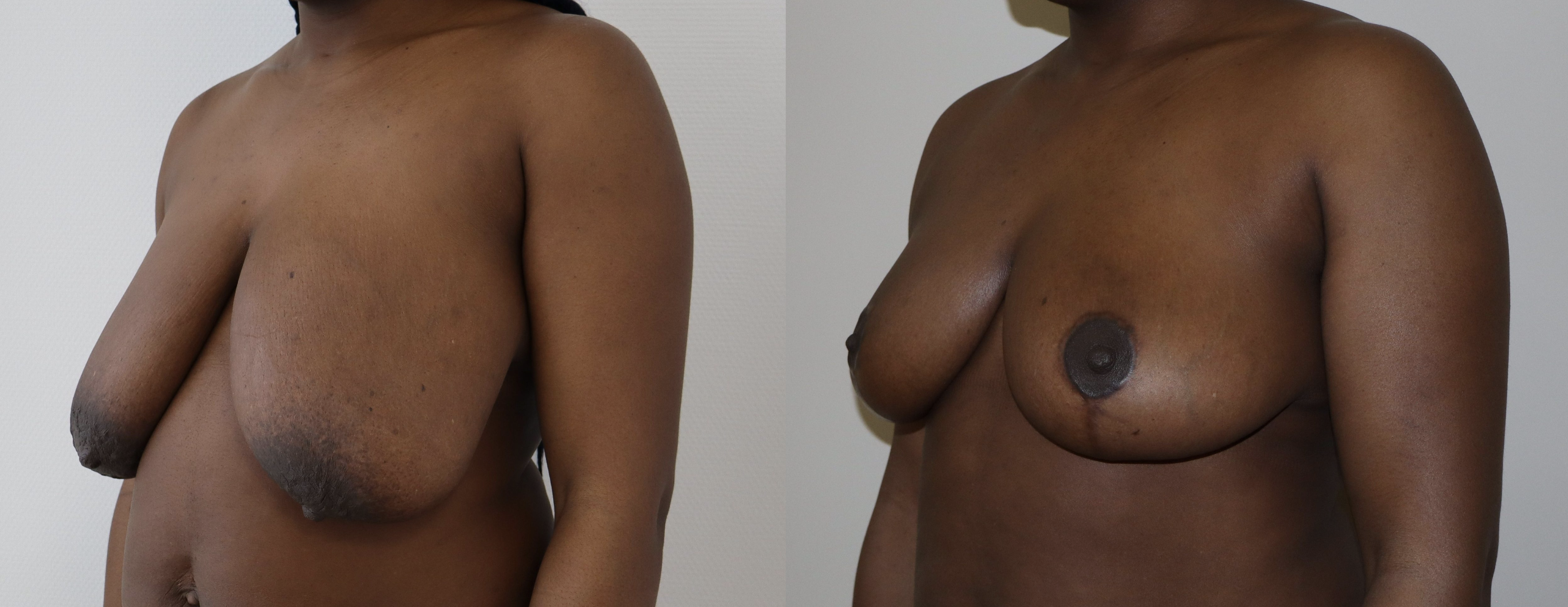 Avant/Après lifting seins et réduction mammaire